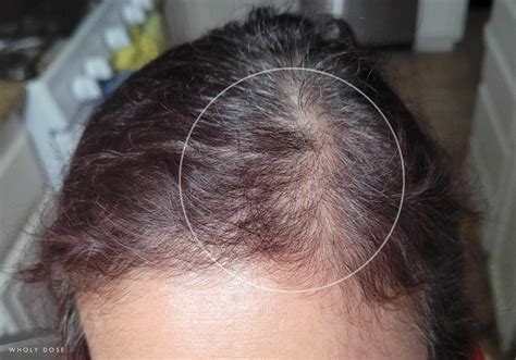 How To Take Biotin For Hair Growth, w/ Before & After Picture Results ...