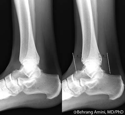 Roentgen Ray Reader: Ankle Effusions and Trauma