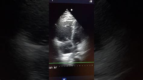 mcconnell sign Mcconnell pulmonary embolism bmj casereports - IMAGE FLUENT