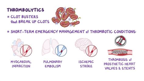 Thrombolytic Therapy - Osmosis Video Library