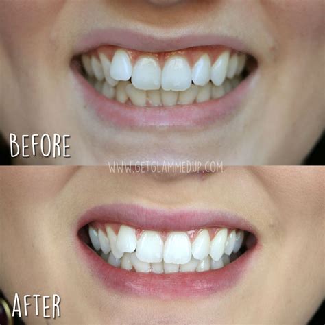 VIDEO: Best Affordable Teeth Whitening Kit - Smile Bright Review & Results: GetGlammedUp ...