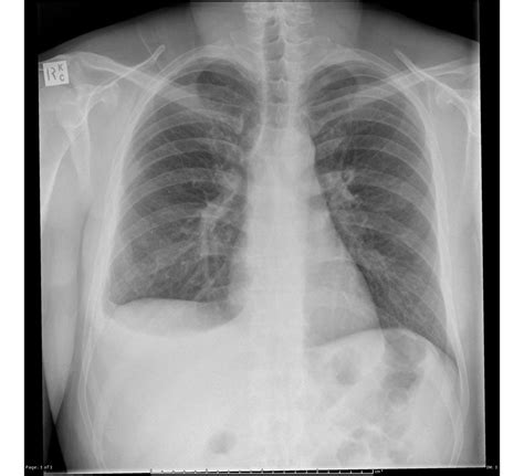 Myxedema coma x ray - wikidoc