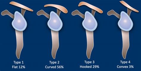 Acromion Types