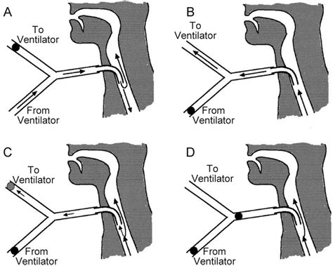 Cuffed Tracheostomy Tube Vs Uncuffed