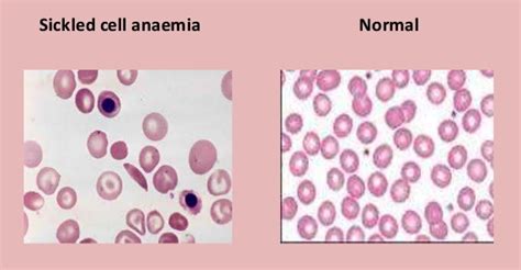 Sickle Cell Blood Smear