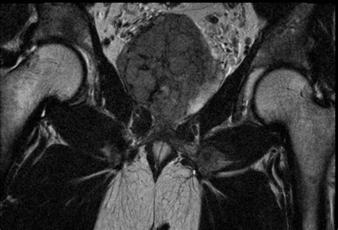 Prostate Mri Scan Showing Cancer