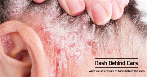 Rash Behind The Ear - Causes & Other Symptoms of Rash On Neck & ears