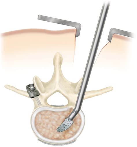 3 Things You May Not Know About Minimally Invasive Spine Surgery