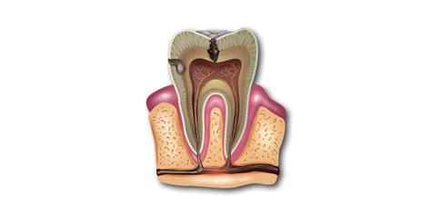 Facts About Root Canal Complications - MY SITE