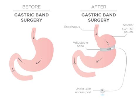 Gastric bands: How it works, surgery, who should have it