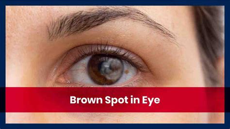 Unsafe Restrict Absurd brown spot on sclera inadvertently Hectares Autonomous