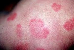 Red Spots On Skin And Kidney Disease