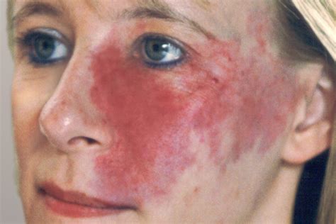 Vascular Birthmarks - Dermatology on Bloor