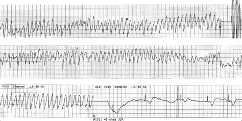 Ecg Shows Polymorphic Ventricular Tachycardia Torsade De Pointes | SexiezPix Web Porn