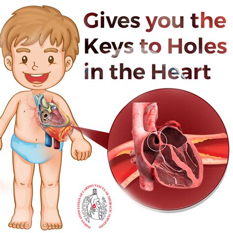 Holes in the heart - what are they? | IACTS