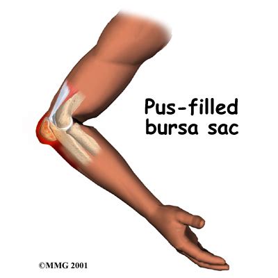 Elbow Bursitis Treatment Richmond, VA | Olecranon Bursitis Treatment Henrico County ...