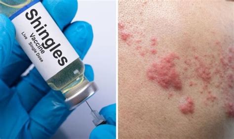 Shingles symptoms: Is shingles contagious? - Sound Health and Lasting Wealth