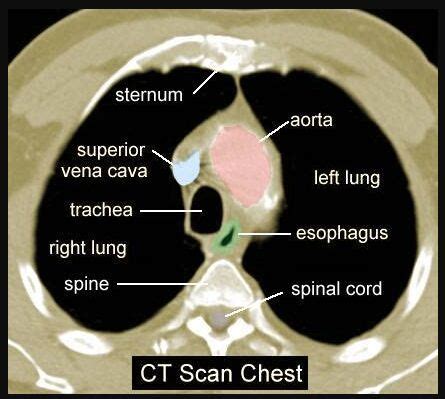 Normal Chest Ct Scan Labeled