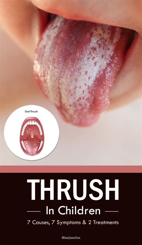 Thrush In Children: Symptoms, Causes And Treatment