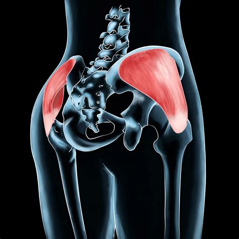 Precision Treatment for Gluteus Medius Injuries