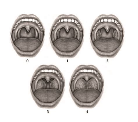 Brodsky grading scale for tonsil. | Download Scientific Diagram