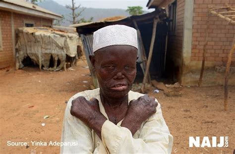 Stigma Against Leprosy Sufferers In Nigeria Results To High Number Of Cases