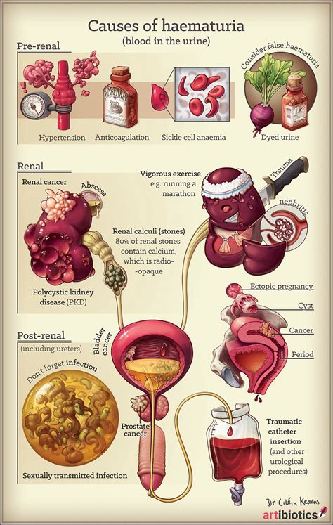 Causes of blood in the urine (haematuria) — artibiotics | Nursing | Nursing assessment, Med surg ...