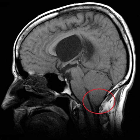 Chiari Malformations | Neurosurgery | Geeky Medics