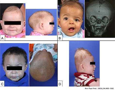 Diagnosis of infant synostotic and nonsynostotic cranial deformities: a review for pediatricians ...