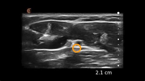 Ulnar Nerve Block | Clarius