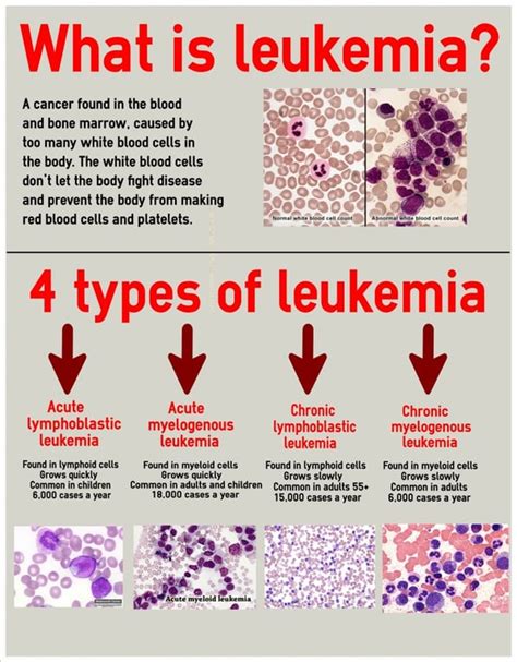 What is Leukemia A cancer found in the blood and bone marrow, caused by ...