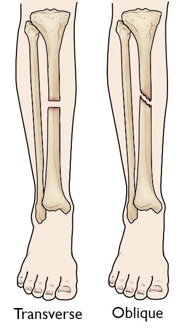 Tibia (Shinbone) Shaft Fractures - OrthoInfo - AAOS