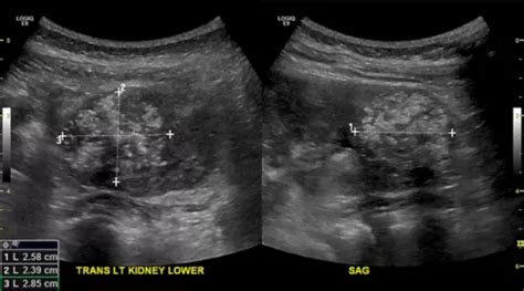 Kidney Ultrasound Tumor