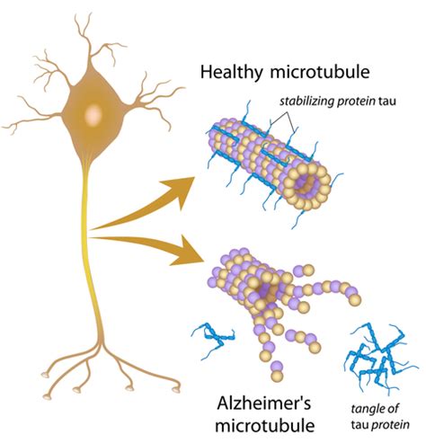 Rheumatoid Arthritis Drug Might Be Repurposed For Alzheimer's Disease | MyBrainTest