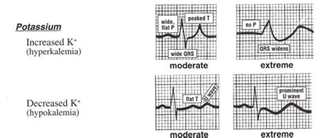 Hypokalemia ECG Changes [With Examples] - Manual of Medicine