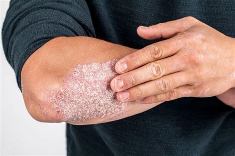 Biologics for Psoriasis - What Our Experts are Saying - U.S ...