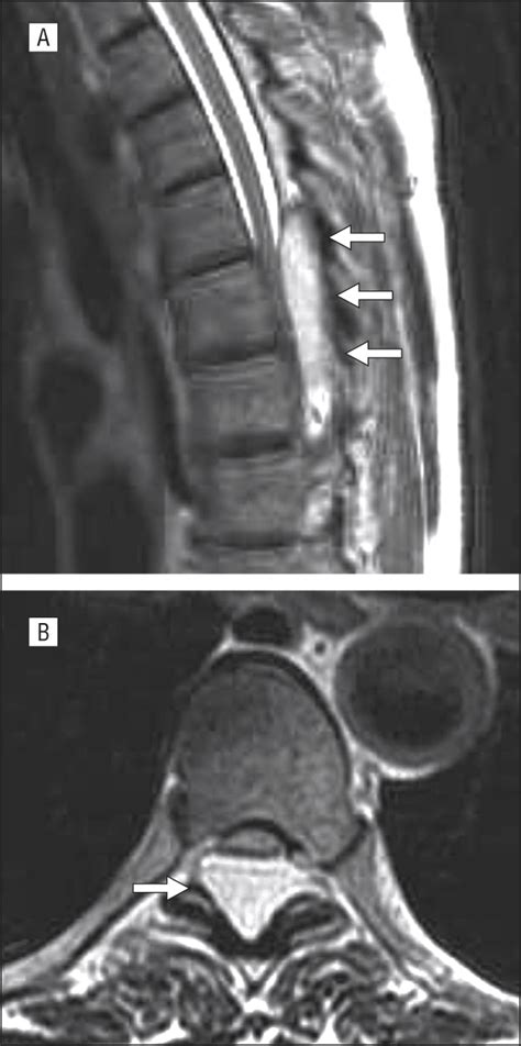 Spinal Cavernous Angiolipoma | Dermatology | JAMA Neurology | JAMA Network