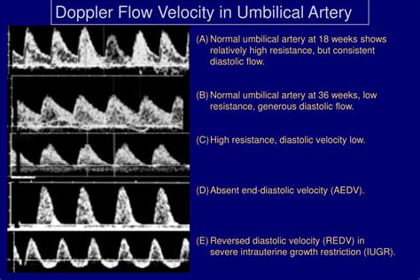 PPT - Doppler Ultrasonography in Obstetrical Practice PowerPoint Presentation - ID:6959533