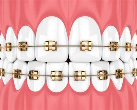 Gold-Plated Braces: The Pros & Cons | Absolute Dental