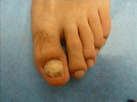 Retronychia Treated with Proximal Nail Avulsion; two Cases Successfully ...