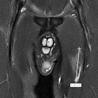 Use MRI for athletes' acute groin pain, study finds