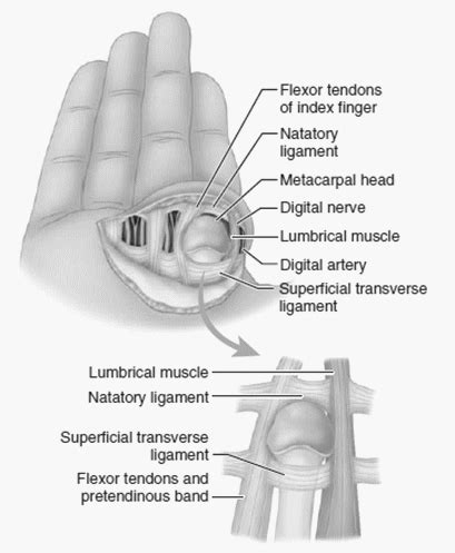 Kaplan’s Lesion : Complex Dorsal MCP joint dislocation | Epomedicine