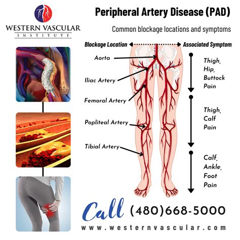 Common PAD blockage sites and symptoms