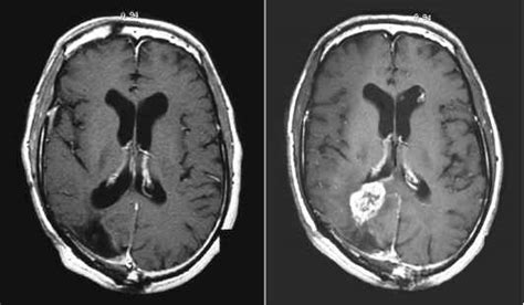 The Bloodbrain Tumor Barrier Effect Of Tumors On The - Brain Tumors