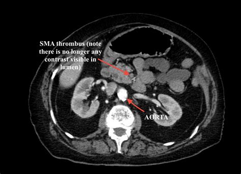 Elderly female with acute abdominal pain presenting with Superior ...