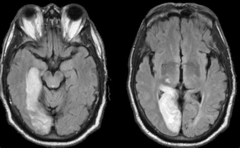 Infarction: Right Occipital Infarct