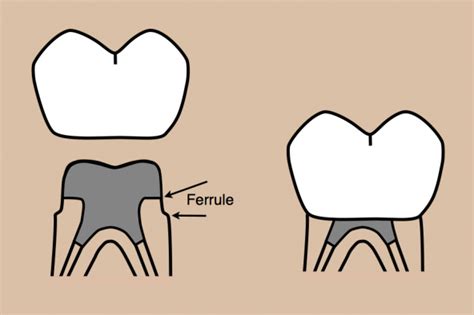 L’effet Ferrule | The Dentalist