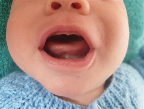 Breastfeeding struggles due to posterior tongue tie - Autumn's Mummy