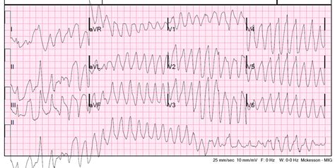 Dr. Smith's ECG Blog: Polymorphic Ventricular Tachycardia