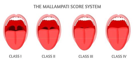 What Is The Mallampati Score? - Faceology